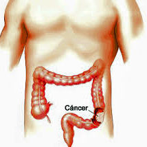 CANCER DE COLON IMAGEN WEB