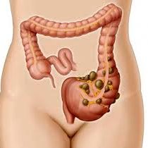 DIVERTICULITIS IMAGEN WEB