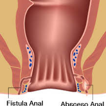 FISTULA ANAL IMAGEN WEB