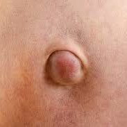 hernia umbilical